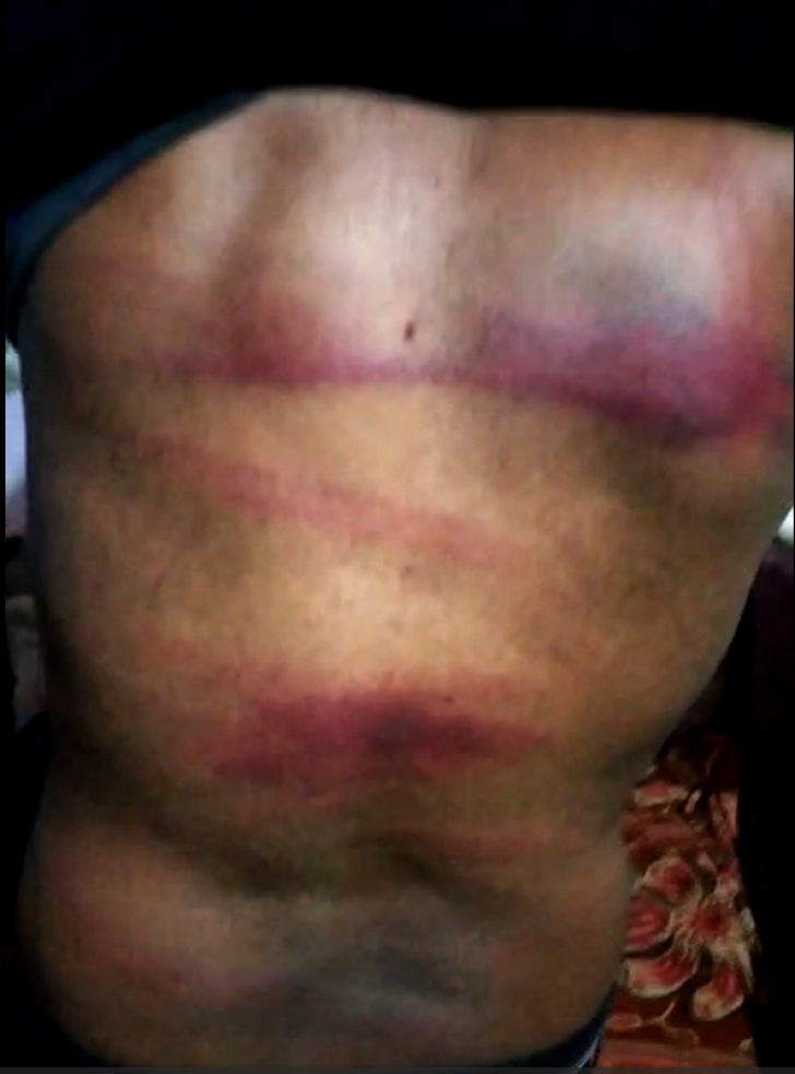 Marks from Muslims beating Azam Masih with iron rods on Jan. 22, 2024 in Sialkot District, Pakistan.
