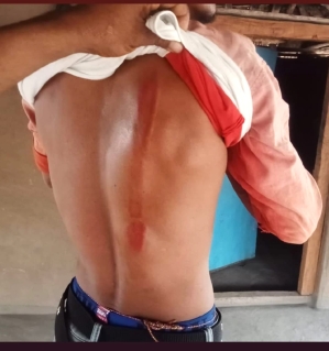 Scar on one of the Christians assaulted in Durandarbha village, Sukma District, Chhattisgarh state, India on April 24, 2025.