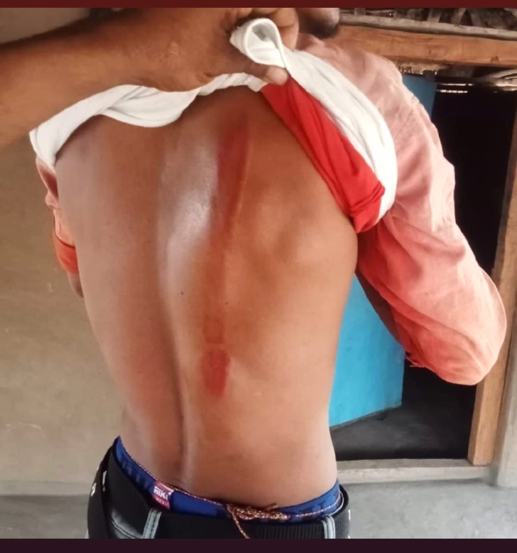 Scar on one of the Christians assaulted in Durandarbha village, Sukma District, Chhattisgarh state, India on April 24, 2025.