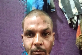 Zahid Morris suffered serious burns on his face and neck after a Muslim set fire to him on Jan. 21, 2026.