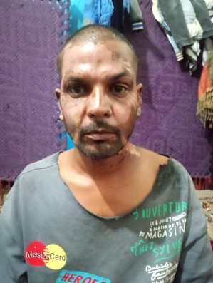 Zahid Morris suffered serious burns on his face and neck after a Muslim set fire to him on Jan. 21, 2026.