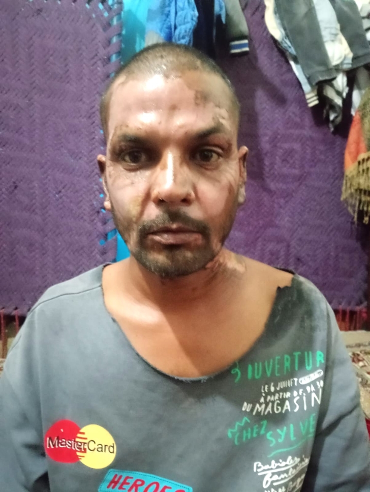 Zahid Morris suffered serious burns on his face and neck after a Muslim set fire to him on Jan. 21, 2026.
