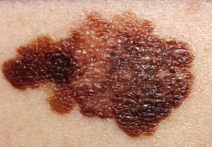 A close-up image shows melanoma on skin.