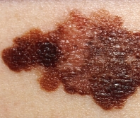 Melanoma vaccine success sparks hope for broader cancer treatment