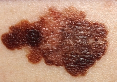 Melanoma vaccine success sparks hope for broader cancer treatment