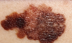 Melanoma vaccine success sparks hope for broader cancer treatment