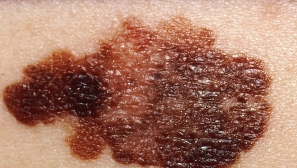 Melanoma vaccine success sparks hope for broader cancer treatment